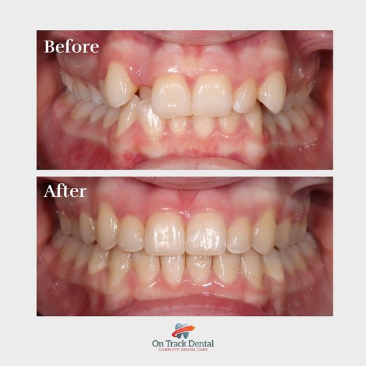 Invisalign Stunning Smile Makeover ❤️