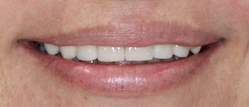 On-Track-Dental-dentist-Melbourne-results-Porcelain-master-after-01-ouevmuh90havem9vzkmgf1bc8p3o54dv785iwaw3ko