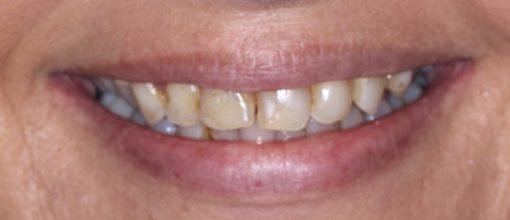 On-Track-Dental-dentist-Melbourne-results-Porcelain-master-before-01-ouevn1zyj5l5zhyyrnvgyzf0zs2lup7pw9deqiky6w
