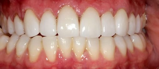 On-Track-Dental-dentist-Melbourne-results-after-02-ouevl6bkv30irkp9qumbzghu81c6ghr1myeg6ldamw