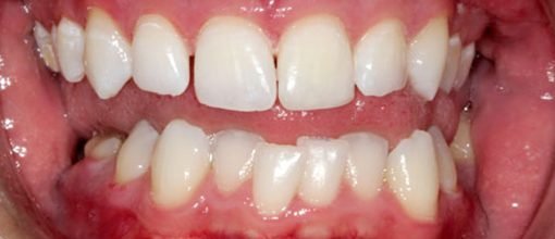 On-Track-Dental-dentist-Melbourne-results-after-03-ouevla2xmf5o20jt4w8u9fjolktnba5yzh0e3p7py0