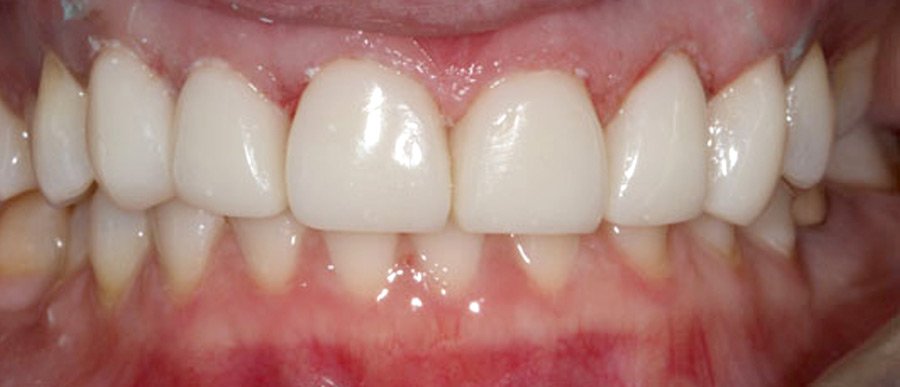 On-Track-Dental-dentist-Melbourne-results-after-04