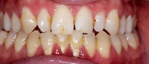On-Track-Dental-dentist-Melbourne-results-before-02-ouevlrxv89u46ltv8lyr2t1fvwdmdj4vdxem7yh8ns