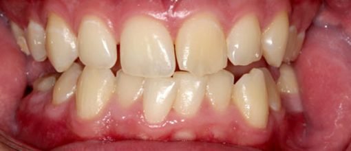 On-Track-Dental-dentist-Melbourne-results-before-03-ouevlvp7zlz9h1oemnl9cs3a9fv38bjsqg0k52bnyw