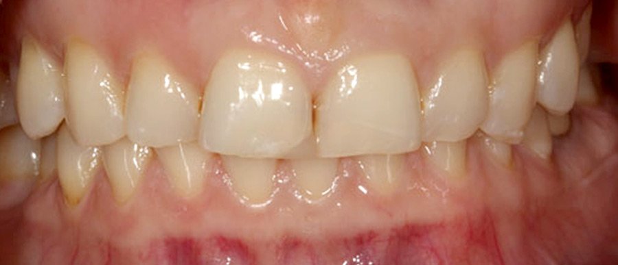 On-Track-Dental-dentist-Melbourne-results-before-04