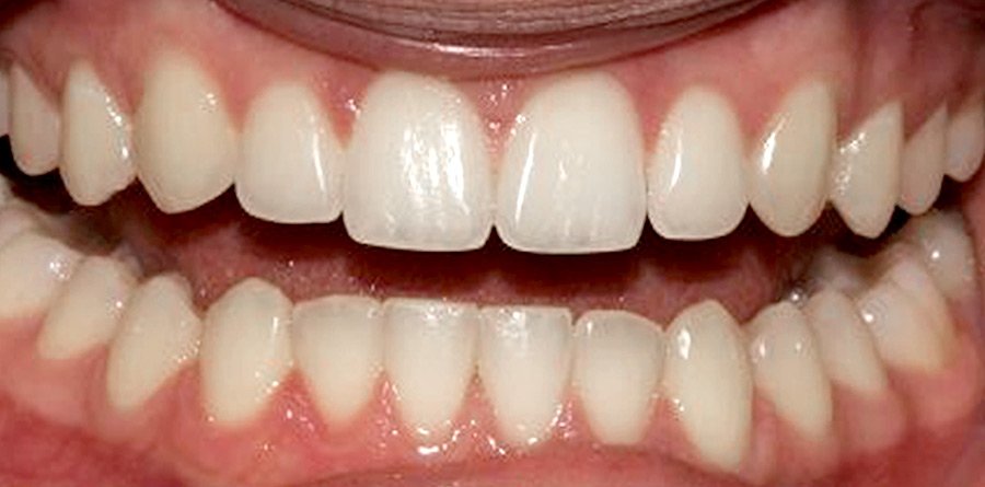 On-Track-Dental-dentist-Rosanna-Melbourne-results-03b