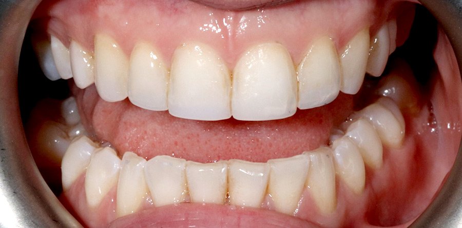 On-Track-Dental-dentist-Rosanna-Melbourne-results-04a