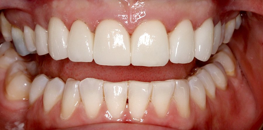 On-Track-Dental-dentist-Rosanna-Melbourne-results-04b