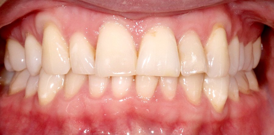 On-Track-Dental-dentist-Rosanna-Melbourne-results-05a