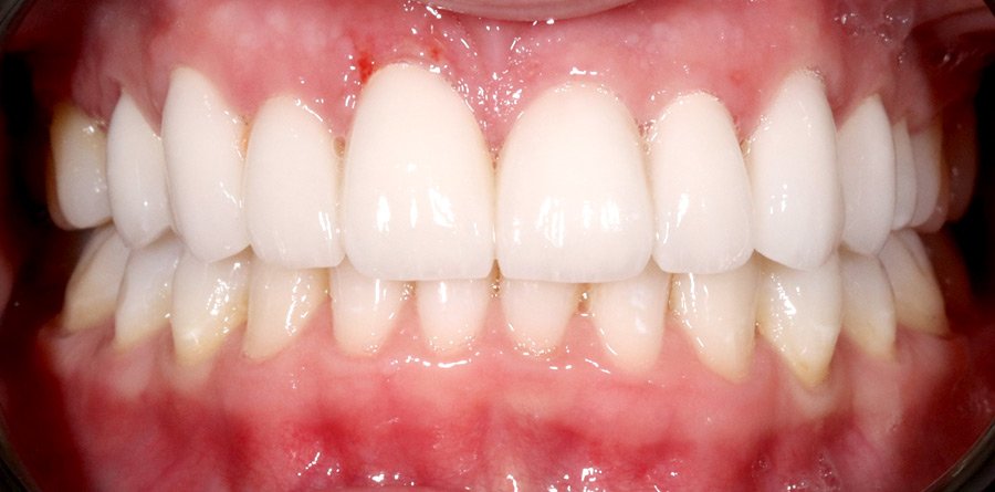 On-Track-Dental-dentist-Rosanna-Melbourne-results-05b