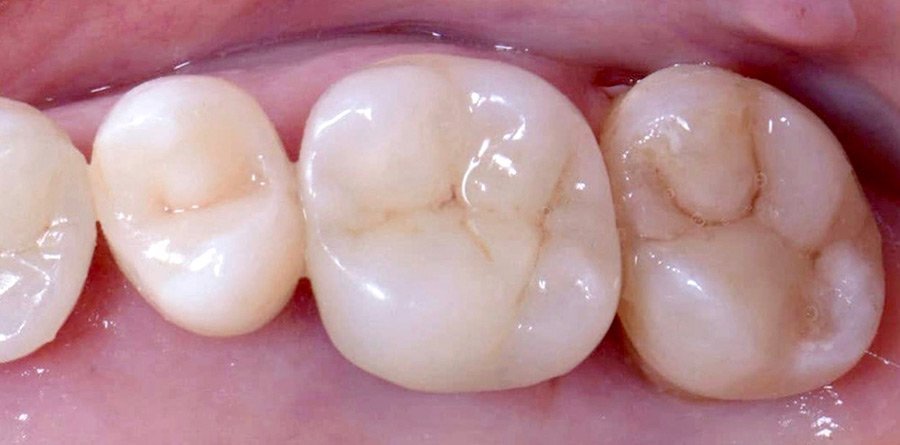 On-Track-Dental-dentist-Rosanna-Melbourne-results-06b