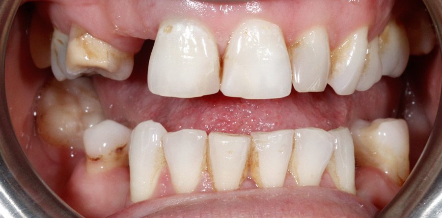 On-Track-Dental-dentist-Rosanna-Melbourne-results-11a-1