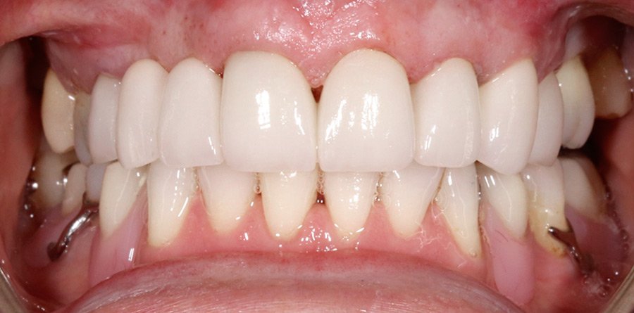 On-Track-Dental-dentist-Rosanna-Melbourne-results-11b-1