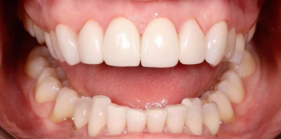On-Track-Dental-dentist-Rosanna-Melbourne-results-12b-1