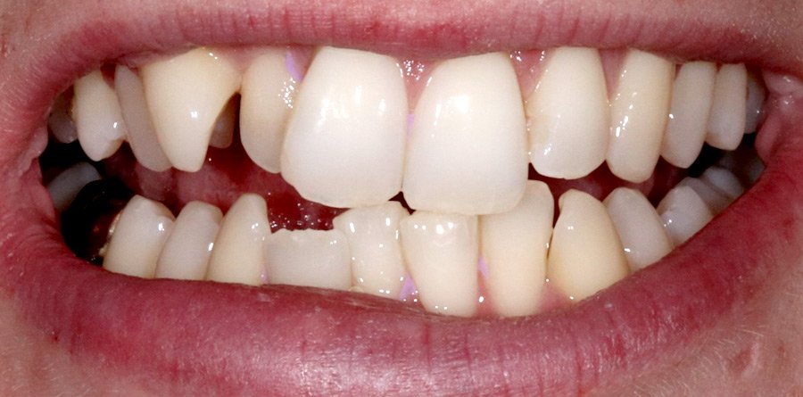 On-Track-Dental-dentist-Rosanna-Melbourne-results-13a