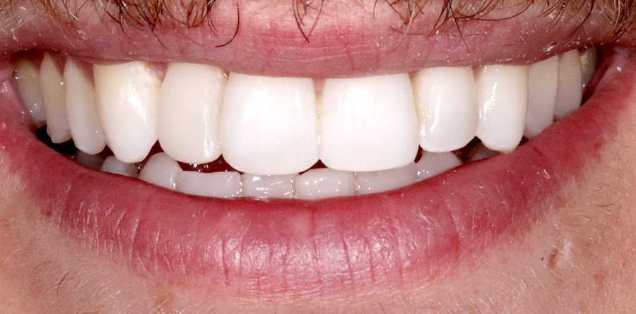 On-Track-Dental-dentist-Rosanna-Melbourne-results-13b