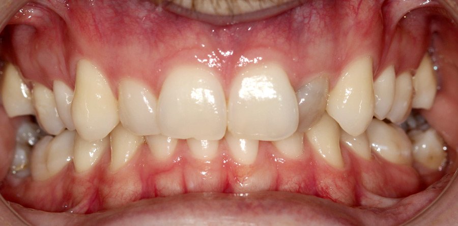 On-Track-Dental-dentist-Rosanna-Melbourne-results-16a-1