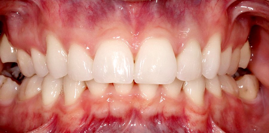 On-Track-Dental-dentist-Rosanna-Melbourne-results-16b-1