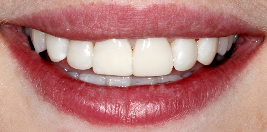 On-Track-Dental-dentist-Rosanna-Melbourne-results-17b